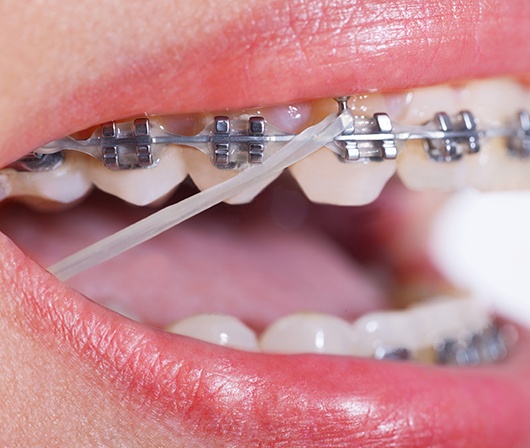 clear elastic on braces