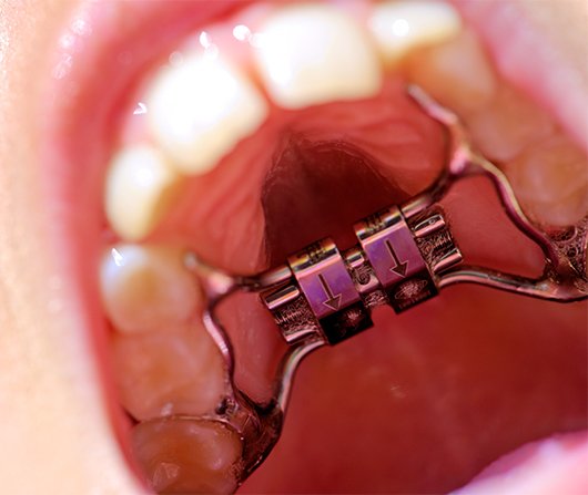 patatal expander in roof of mouth
