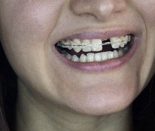 An up-close look at a person’s smile that consists of a missing tooth and dental braces