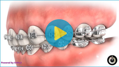 orthodontic parts video/></a></p>
	</div>
	<div>
<h2>Wax Placement</h2>
<p><a href=