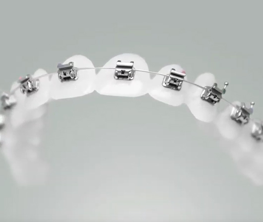 self ligating braces on model teeth