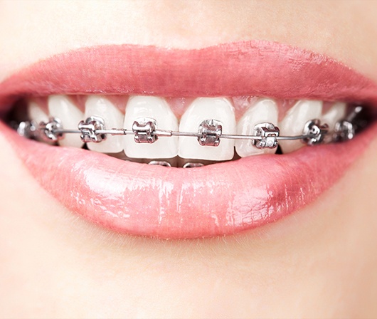 close up of self litagating braces