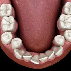 Illustration of crooked teeth