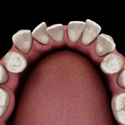 Illustration of gapped teeth