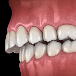 Illustration of an overbite