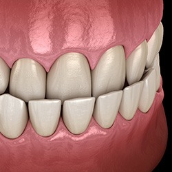 Illustration of an underbite
