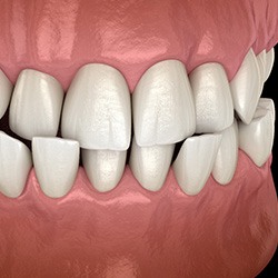 Illustration of a crossbite