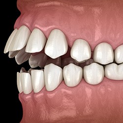 Illustration of an open bite