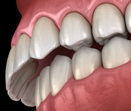 A digital image of an overbite  