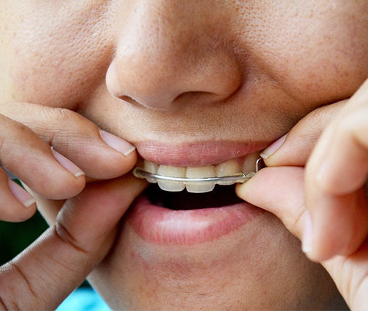 girl putting in retainer