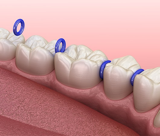 computer illustration of separators