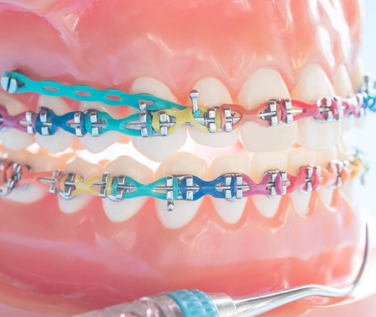 a close-up of braces on a model of a mouth