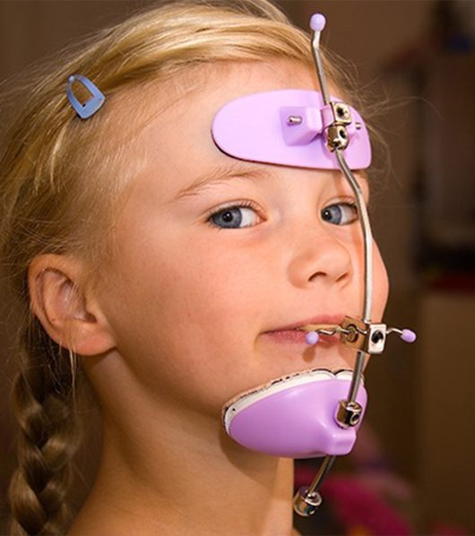 young girl with dentofacial orthopedics