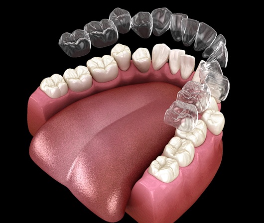 A digital image of an Invisalign aligner going on over the lower arch of teeth