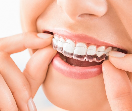 close up of woman putting in invisalign tray