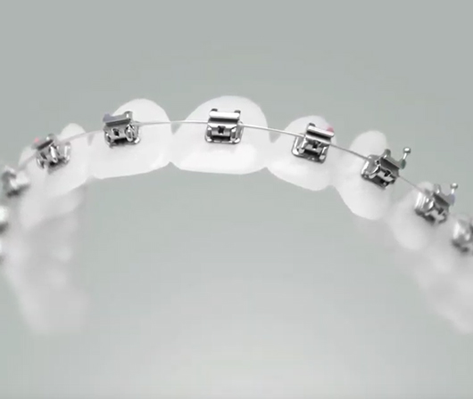 Traditional Braces Atlanta, GA, Self-Ligating Orthodontics