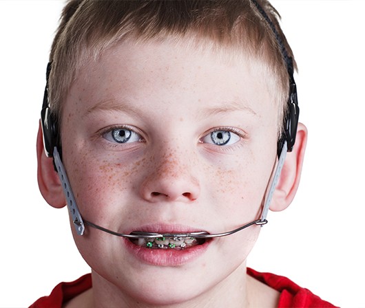 Boy with Dentofacial Orthopedics