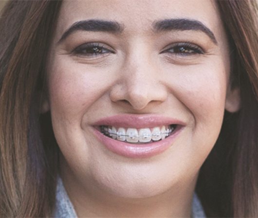 Close up of woman with ceramic braces