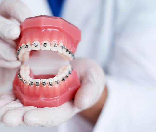 Closeup of model of teeth with traditional braces