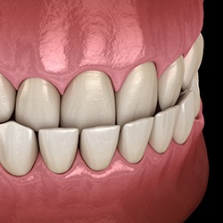 Illustration of patient with underbite