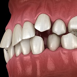 Illustration of patient with crooked teeth