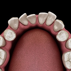 Illustration of gapped teeth