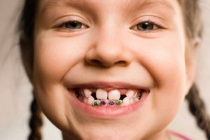 child with Phase 1 orthodontics