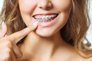 Woman pointing at her braces with manicured finger